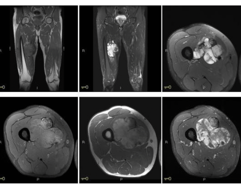 ortopedista oncológica especializada em tumores musculoesqueléticos em São Paulo.