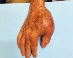 paciente com osteossarcoma para cirurgia oncológica ortopédica