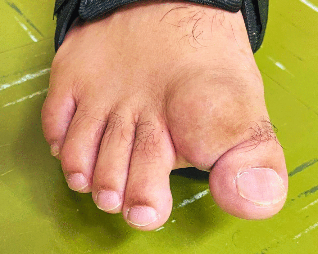 Tumores ósseos e de partes moles são lesões anômalas que podem surgir em qualquer faixa etária. Esses crescimentos podem acometer estruturas como ossos, músculos, tendões, nervos, fáscias e tecido subcutâneo. Embora a maior parte seja benigna, existem formas malignas que exigem diagnóstico rápido e abordagem oncológica especializada. Para garantir a melhor sobrevida e a preservação da função, o paciente deve ser avaliado por um ortopedista oncológico experiente, como a Dra. Karen Voltan, que atua em São Paulo na Stem Ortopedia Biológica e no Hospital Israelita Albert Einstein – Unidade Klabin. A seguir, apresentamos uma visão abrangente do que são tumores ósseos e de partes moles, suas causas, sinais e sintomas de alerta, e as opções de tratamento disponíveis atualmente, sempre priorizando a tecnologia de ponta, a experiência clínica e o cuidado humanizado. O Que São Tumores Ósseos e de Partes Moles? Conceito e Classificação Tumores Musculoesqueléticos englobam qualquer neoplasia que se desenvolve nos componentes do sistema de suporte e movimentação do corpo — ossos, cartilagens, músculos, tendões, nervos, fáscias. São classificados em dois grandes grupos: Tumores Ósseos: Podem ser benignos (por exemplo: cistos ósseos simples, aneurismáticos, encondromas, osteocondromas) ou malignos (osteossarcomas, sarcoma de Ewing, condrossarcomas, metástases ósseas, mieloma múltiplo). Tumores de Partes Moles: Incluem lesões localizadas nos músculos, tendões, nervos e tecido conjuntivo superficial ou profundo. Podem ser benignos (lipomas, desmóides, tumores de células gigantes de bainha de tendão, Schwanomas, etc) ou malignos (lipossarcoma, sarcoma sinovial, sarcoma indiferenciado, rabdomiossarcoma e etc). Nem todos os tumores musculoesqueléticos causam sintomas precoces. Alguns podem ser achados incidentais em exames de imagem de rotina, enquanto outros apresentam dor contínua, aumento de volume ou impacto funcional que leva à investigação mais aprofundada. Causas e Fatores de Risco Por que se Desenvolvem? O surgimento de tumores ósseos e de partes moles está ligado a múltiplos fatores, embora as causas exatas muitas vezes permaneçam desconhecidas. Alguns dos fatores de risco já identificados incluem: Predisposição Genética: Síndromes hereditárias como síndrome de Li-Fraumeni e síndrome de Rothmund-Thomson aumentam a chance de osteossarcoma em jovens. Doenças Ósseas Benignas: Pacientes com condições como displasia fibrosa poliostótica, osteocondroma multiplo, encondromatose familiar e etc têm risco maior de transformação maligna. Radiação Ionizante: Exposição prévia a radioterapia, principalmente em crianças e adolescentes, pode predispor ao desenvolvimento de sarcomas ósseos ou de partes moles décadas depois. Exposição a Agentes Químicos: Alguns estudos associam agentes industriais (arsênio, benzeno) a um risco ligeiramente aumentado de sarcomas de partes moles. Porém, a maioria dos tumores musculoesqueléticos surge sem fator de risco identificável. Por isso, o acompanhamento de qualquer sinal de alerta — dor sem causa aparente, aumento de volume rápido, fraturas inexplicadas — é fundamental. Sintomas de Tumores Ósseos e de Partes Moles Identificando Sinais de Alerta Embora cada tipo de tumor apresente características específicas, existem sintomas gerais que devem motivar busca imediata por avaliação médica: Dor Persistente e Progressiva: Dor óssea ou muscular que piora com o tempo e não melhora adequadamente com repouso ou analgésicos comuns. Aumento de Volume ou Massa Palpável: Sensação de “caroço” firme, podendo ser indolor inicialmente, mas crescendo rapidamente ou lentamente. Rigidez e Limitação de Mobilidade: Dificuldade para movimentar articulações próximas ao local do tumor, muitas vezes confundida com sobrecarga ou tendinite. Edema e Eritema Local: Inflamação visível, calor e vermelhidão, especialmente em tumores de partes moles que crescem rapidamente e comprometem a circulação local. Fraturas Patológicas: o osso enfraquece e pode sofrer fraturas com traumas mínimos ou até mesmo de maneira espontânea. Sintomas Sistêmicos (casos avançados): Perda de peso, fadiga, febre baixa, sinais de anemia podem estar presentes em tumores metastáticos ou sanguíneos. Cada caso deve ser avaliado de forma individualizada pela Dra. Karen Voltan, que coleta histórico detalhado, examina possíveis causas associadas (traumas, histórico familiar, outras doenças) e investiga com exames apropriados. Diagnóstico de Tumores Musculoesqueléticos Exames-Iniciais e Avaliação Clínica O processo diagnóstico inicia-se com: Histórico Clínico Completo: Inclui duração e padrão da dor, evolução de sinais e presença de sintomas sistêmicos. Exame Físico Detalhado: Palpação para identificar pontos de dor, massas ou irregularidades ósseas, além de avaliação do estado neurológico e vascular do membro afetado. Radiografia Simples: Útil para visualizar alterações na arquitetura óssea e orientar a necessidade de exames mais avançados. Exames de Imagem Complementares Tomografia Computadorizada (TC): Detalha a extensão cortical e possíveis calcificações intratumorais, além de orientar biópsias guiadas. Ressonância Magnética (RM): Essencial para os tumores musculoesqueléticos e avaliar a invasão de tecidos adjacentes, além de definir margens cirúrgicas. Cintilografia Óssea ou PET-CT: Para rastrear possíveis metástases em ossos distantes ou em outros órgãos. Biópsia e Avaliação Histopatológica A biópsia é o exame muitas vezes necessário que deve ser realizado preferencialmente por um ortopedista oncológico ou radiologista intervencionista. O material coletado é analisado em laboratório anatomopatológico e orientando o tipo de tratamento. O planejamento na execução da biópsia impacta diretamente na taxa de cura e na preservação de estruturas. Manejo Multidisciplinar Importância do Trabalho em Equipe O combate a tumores musculoesqueléticos requer equipe especializada: Ortopedista Oncológico (Dra. Karen Voltan): Lidera o diagnóstico, planeja a cirurgia oncológica e acompanha toda a jornada clínica. Oncologista Clínico: Indica e ajusta protocolos de quimioterapia neoadjuvante e adjuvante, conforme tipo histológico e resposta ao tratamento. Radioterapeuta: Avalia necessidade de radioterapia neoadjuvante ou adjuvante, principalmente em sarcomas de partes moles. Fisioterapeuta: Conduz reabilitação precoce para preservar função muscular e articular pós-cirurgia. Patologista: Analisa biópsias e fornece laudo preciso do tipo de tumor e grau de agressividade. Radiologista: Realiza e interpreta exames de imagem (RM, TC, PET-CT) para estadiamento e monitoramento da resposta. Equipe de Enfermagem e Suporte Psicológico: Oferece acolhimento, informações e ajuda na adesão ao tratamento. Quando Procurar Ajuda Especializada Sinais de Alerta para Busca Imediata Você deve agendar consulta com a Dra. Karen Voltan se: Sentir dor óssea ou muscular persistente sem explicação clara, que piora à noite ou não cede com analgésicos comuns. Encontrar massa ou caroço firme sob a pele que cresce rapidamente ou não desaparece em semanas. Sofrer fratura espontânea com mínimo ou nenhum trauma, especialmente em adolescentes. Notar inchaço local, rubor ou calor persistentes na articulação ou músculo acompanhado de dor. Receber resultado de exame de imagem indicando lesão óssea ou massa de partes moles . Locais de Atendimento em São Paulo Stem Ortopedia Biológica Av. Brasil, 299 – Jardim América, São Paulo www.stemortopedia.com Hospital Israelita Albert Einstein – Unidade Klabin Av. Ricardo Jafet, 1600 – São Paulo www.einstein.br Tumores ósseos e de partes moles envolvem uma variedade de lesões que vão de condições benignas e assintomáticas a neoplasias agressivas que ameaçam a função e a vida. A oncologia ortopédica, coordenada por especialistas como a Dra. Karen Voltan, realiza diagnóstico precoce, planejamento cirúrgico preciso e reabilitação focada em preservar a independência do paciente. Se você ou um familiar apresenta sinais sugestivos — dor persistente, massa ou fratura inexplicável — agende sua consulta com a Dra. Karen Voltan para avaliação imediata e tratamento especializado em São Paulo. Clique aqui e agende uma consulta com a Dra. Karen Voltan, referência em oncologia ortopédica, ou ligue para (11) 94487-2456 para atendimento rápido e humanizado. https://drakarenvoltan.com/agendamento paciente com tumor ósseo em São Paulo