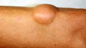 lipossarcomas de partes moles